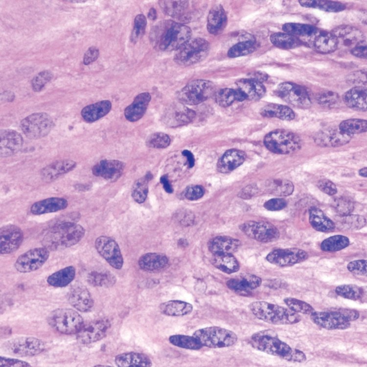 CraigHorbinski's tweet image. Gorgeous #anaphase #mitosis in a grade II #meningioma. You can even see the #microtubules in the mitotic spindle. 
Yeah, I'm the right profession! 🔬👍🏼
#pathology #neuropath #brain