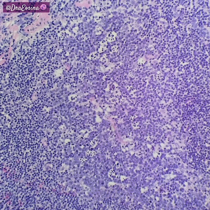 🍄 Polypoid lymphoid hyperplasia of the large bowel.
Usually found for rectal bleeding in children. Lymphomas must be ruled out, but uncommon. A lesion not to worry!
#GIPath #HemePath #PediPath #Pathology