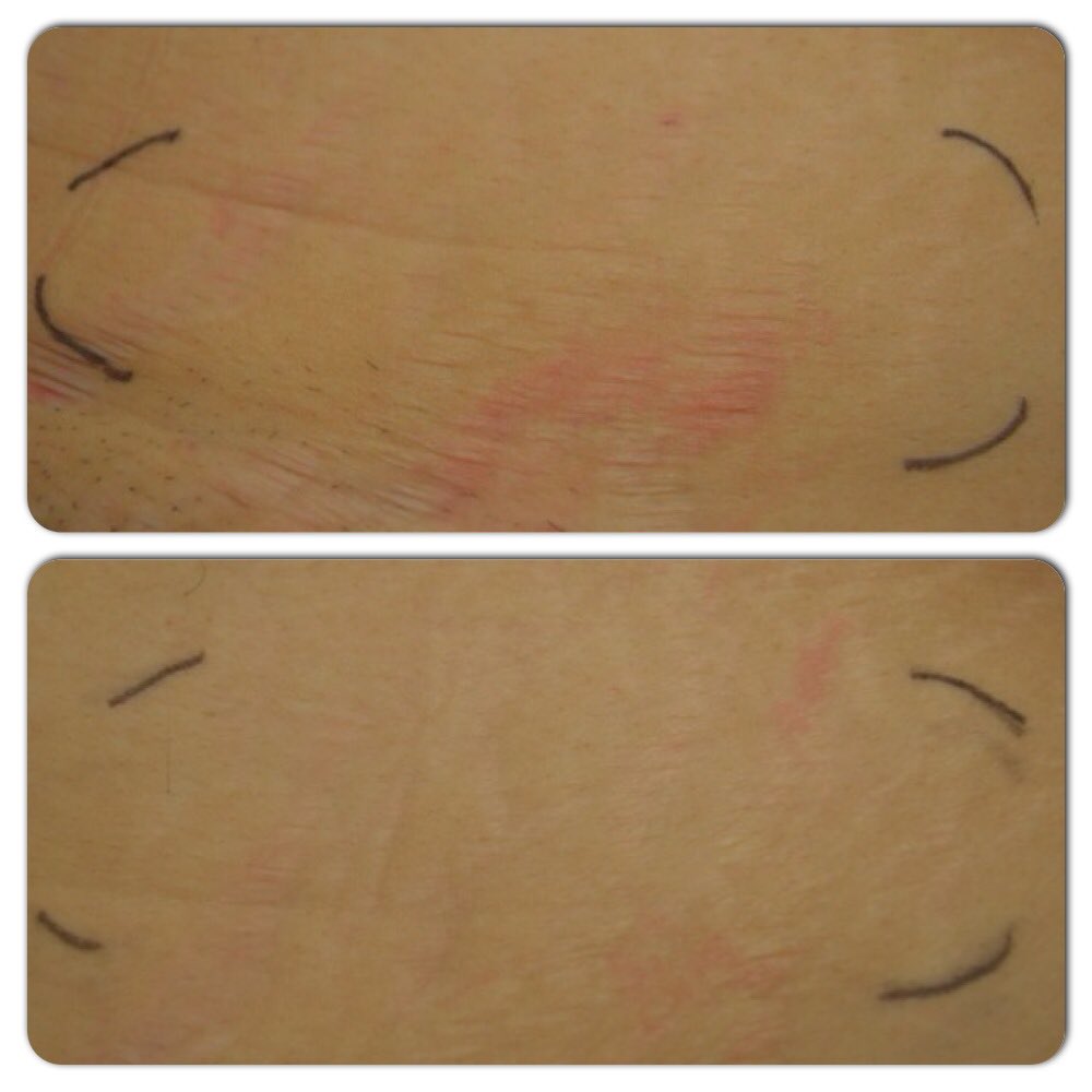 Strialite's tweet photo. Yes! Strialite does really work! Purchase yours online today at @nordstrom @neimanmarcus @amazon ! #stretchmarks #strialite #stralitemachine #beauty #skin #skincare #nordstrom #neimanmarcus #amazonprime https://t.co/RyvzWKfm6q