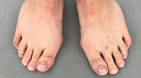 orthopro1's tweet photo. #Bequemschuhe bei Hallux valgus zu tragen, bedeutet, dass Folgeprobleme an den anderen Zehen vermieden werden.
https://t.co/ynuHnmpTWP
#halluxvalgus #halluxvalgusschuhe https://t.co/uZb4ztXUU3