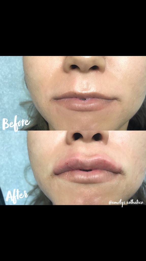 DrMarcosikeda's tweet photo. Filler Friday’s - Before &amp; After 👄
🔎Juvederm Ultra XC
💰$500-$700
📞 281-864-0000 schedule a free consultation.
📍Dr. Marcos Cosmetic Surgery &amp; Medspa .
#fridaylips #lipinjections #juvedermultra #beforeandafter #emilysesthetics #drmarcosikeda #houstondoctors #lipaugmentation https://t.co/ej8kNsEQMf