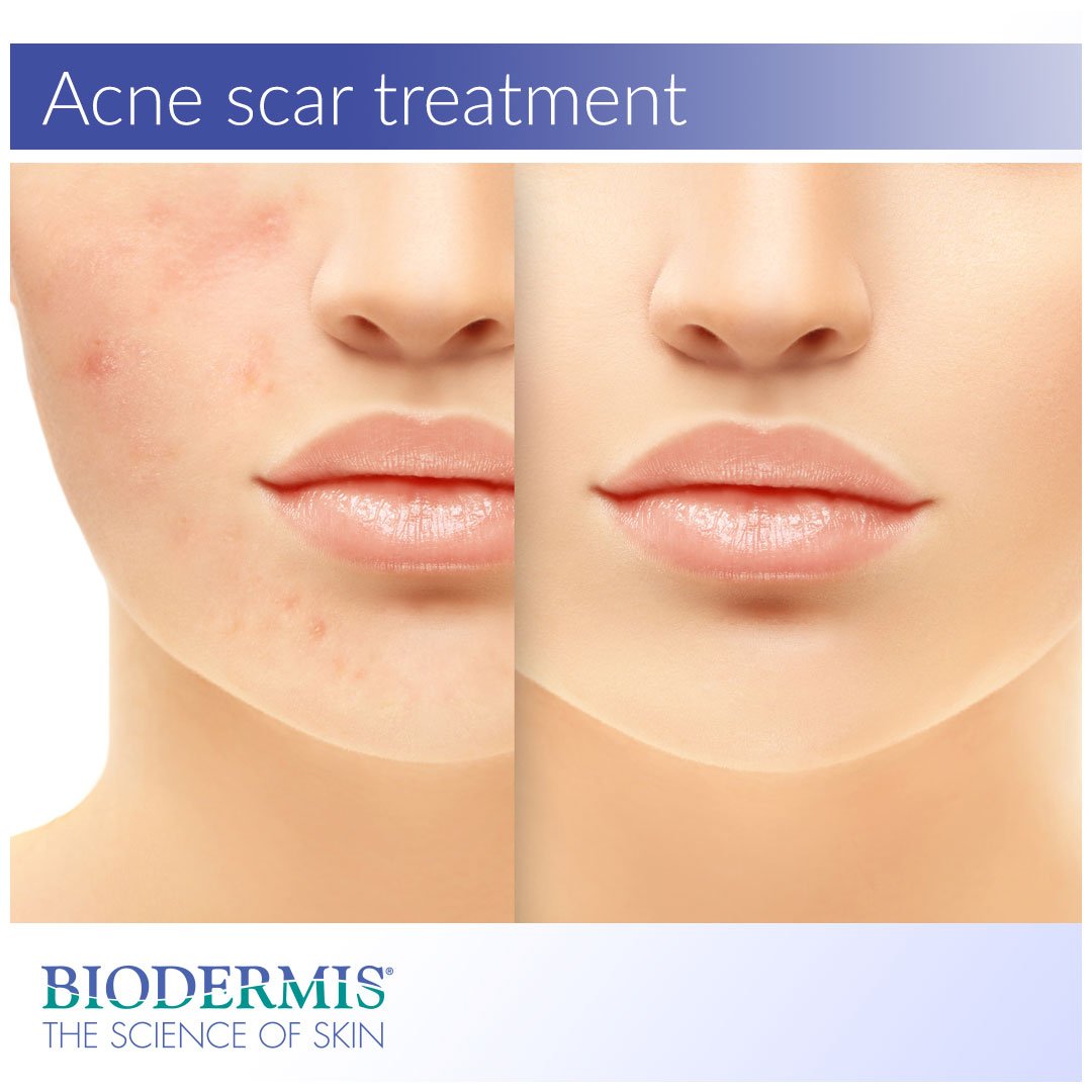 Biodermis's tweet photo. Explore clinically-proven silicone solutions that can help proactively prevent acne scarring. Full article: https://t.co/X745NPxng7
#biodermis #silicone #acnescars #acne #scars #prosil #epiderm #xeragel #siliconegel https://t.co/K17cDraWsY
