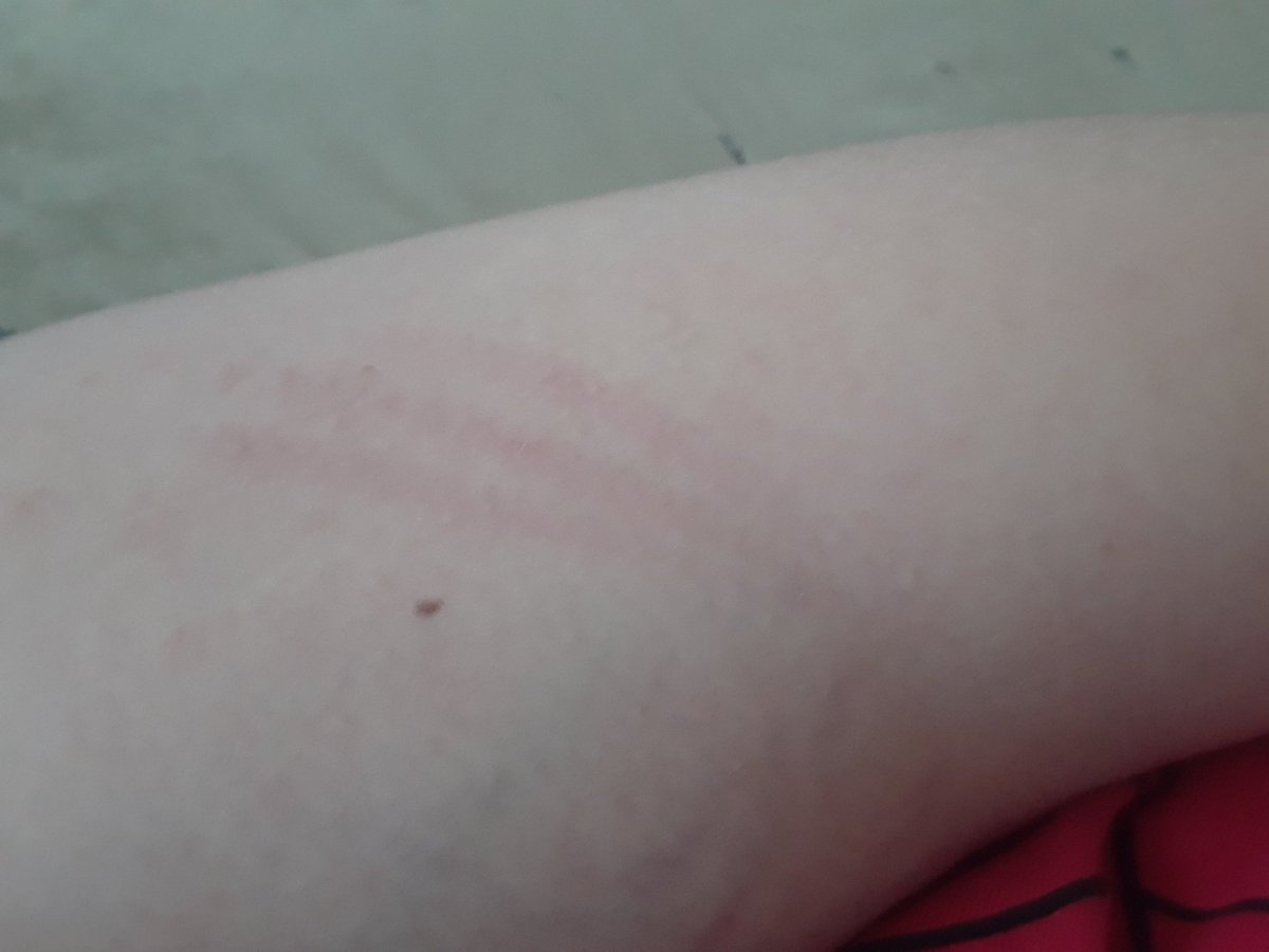 dog scratch on arm