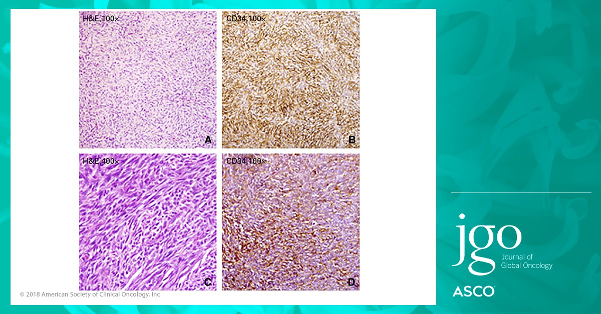 JCOGO_ASCO's tweet photo. Treatment of dermatofibrosarcoma protuberans with imatinib in India: a case series https://t.co/8YLlhXzzH8 https://t.co/ku39lrgLNf