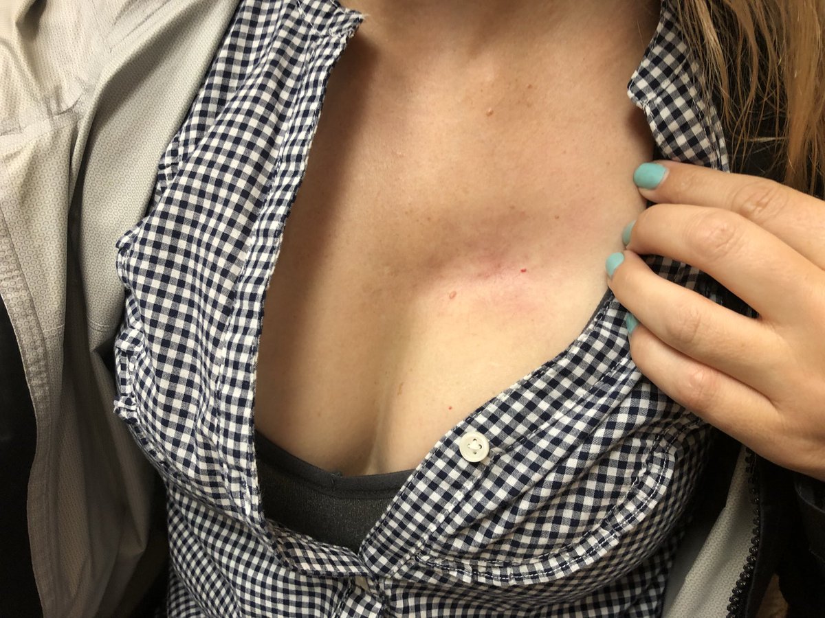 rogshw's tweet photo. 33 yo female with stage IV met breast cancer. Bx proven chest lesion+chest wall involvement. No surgical candidate. Cryo abl x2. Cryo from Wall to protected skin.  No chemo.  Only hormone tx. 2 year f/u.@BTGIO @SIRRFS m#@BrandonKangMD @jdprologo https://t.co/8KI3VUHFUu
