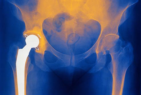 KangHipandKnee's tweet photo. Hip revision is a great surgery as long as there’s an underlying cause for doing the revision. Learn more in the link below:
https://t.co/X2qXShdAFx https://t.co/pQw7ee1YcZ