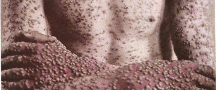 Infectiousdis2's tweet photo. Planning for #smallpox outbreak must consider #immunosuppression.
@Infectiousdis2 
For more details: Visit Journal of Infectious Diseases &amp; Immune Therapies home Page.. https://t.co/jMzHK4WaNU