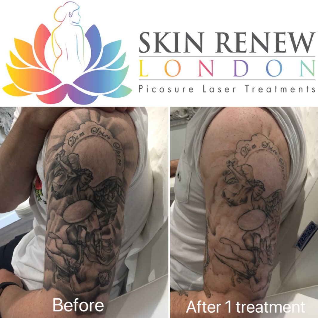 Skin Renew London on Twitter: Skin Renew London on Twitter: