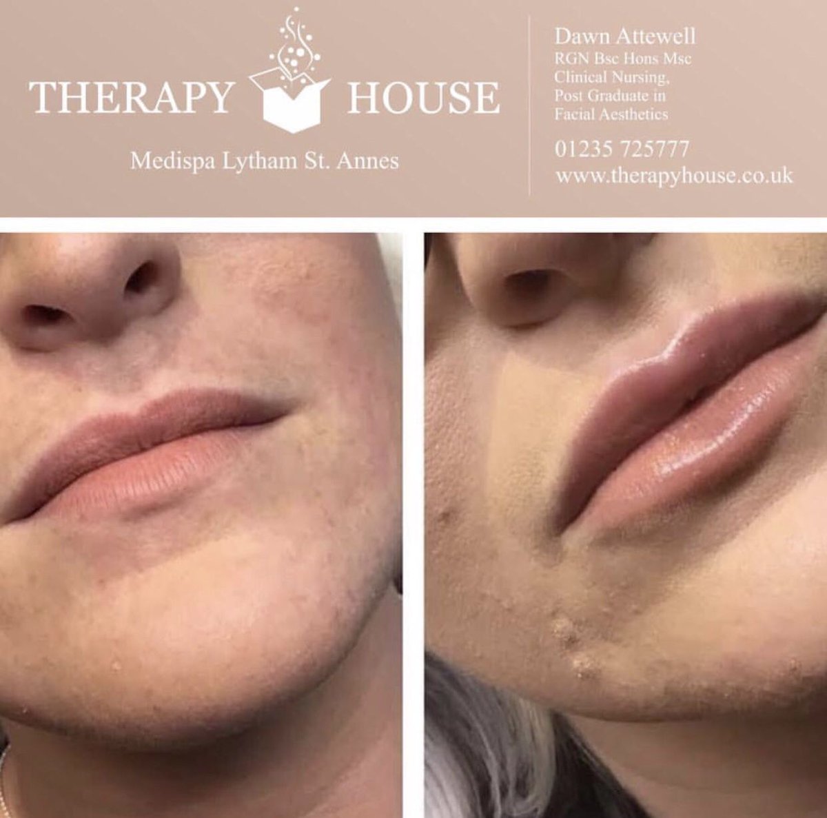Therapyhouse1's tweet photo. ✨ BEFORE AND AFTER ✨⠀
⠀
Lip augmentation 💗

 #cosmetics #bblogger #bbloggers #wakeupandmakeup #slave2beauty #antiageing #beautyskin #beautycare #perfectskin #flawlessskin #foreveryoung  #glowingskin #skinperfect https://t.co/CsxdOCdh5f