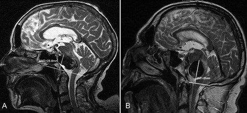 Toward a Containment Strategy for Smallpox Bioterror: An Individual Based Computational