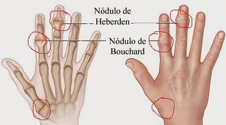 Perthes Disease