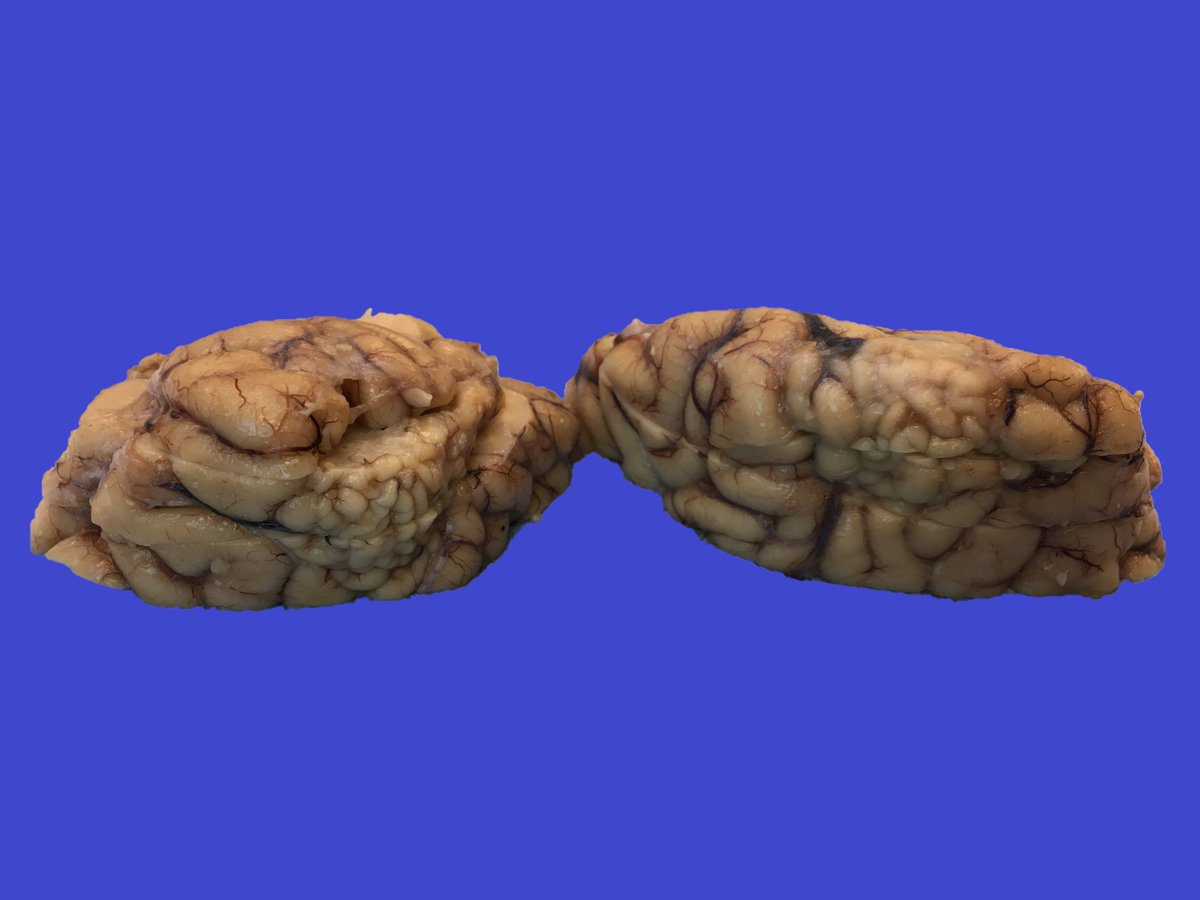 HopkinsNeuropth's tweet photo. Middle aged person with epilepsy found to have polymicrogyria of the bilateral occipital poles. https://t.co/DXhxsEqHZS