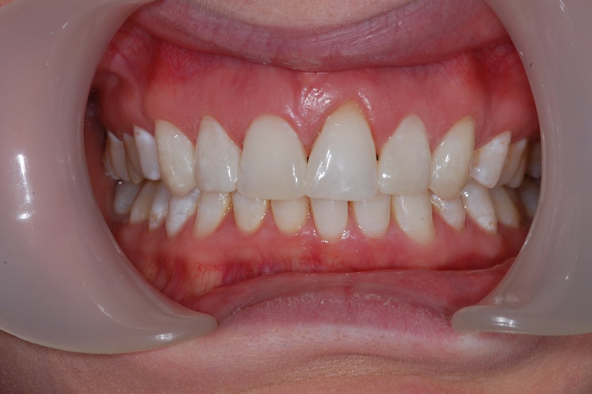 Nick Daily-Hunt (@nickd_h) on Twitter photo Another nice #cosmetic result by Nick <a href="/AlbertPlace/">Adam Noble</a> using @VOCOuk Amaris. #happypatient #dentist #dentistry <a href="/VOCOAmerica/">VOCO America Inc</a> #smile Another nice #cosmetic result by Nick <a href="/AlbertPlace/">Adam Noble</a> using @VOCOuk Amaris. #happypatient #dentist #dentistry <a href="/VOCOAmerica/">VOCO America Inc</a> #smile