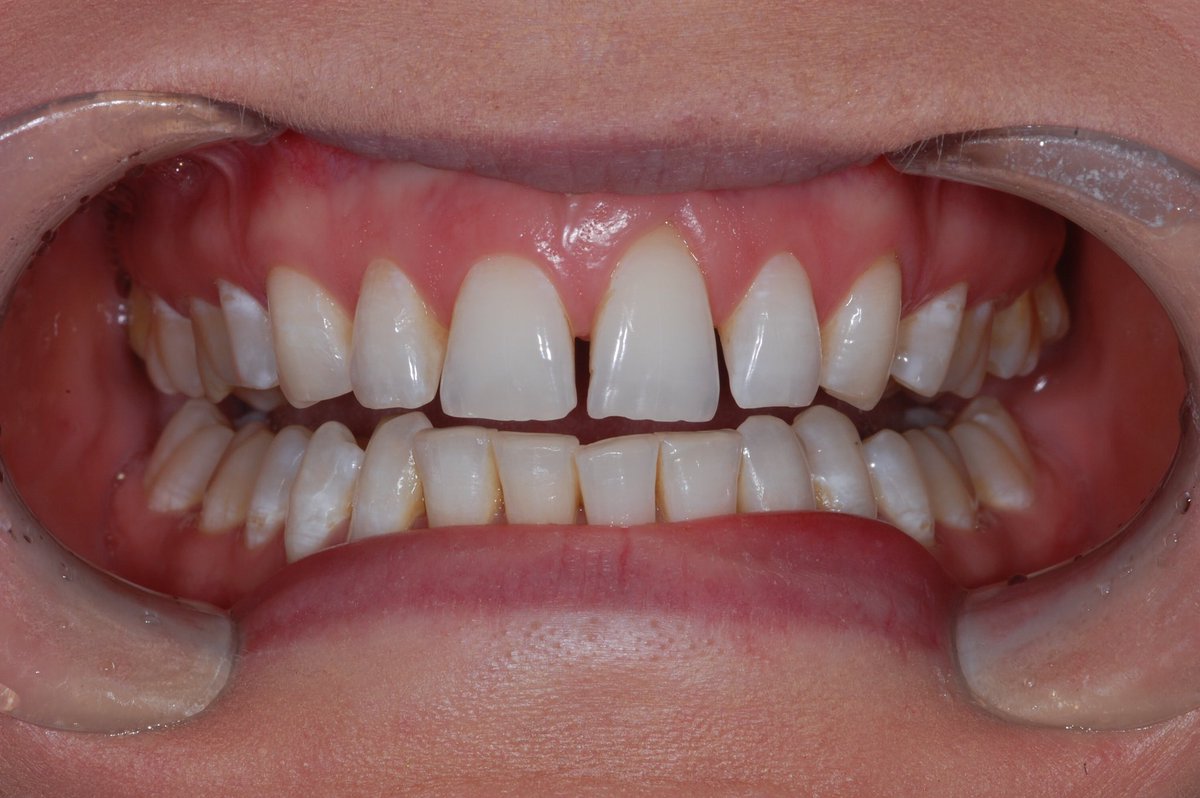 NickD_H's tweet photo. Another nice #cosmetic result by Nick @AlbertPlace  using @VOCOuk Amaris. #happypatient #dentist #dentistry @VOCOAmerica  #smile https://t.co/G6n7Airn4G