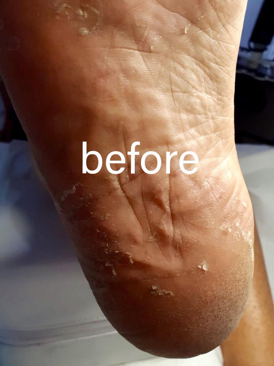 TheWorksDublin's tweet photo. Have you tried #drypedicure yet? Only 1 #treatment to see visible improvements! Our #naildrill #Gharieni guarantees best results in removing dead #skin! Book treatment now  01 490 7178 &amp; !
#theworkssalon #beauty #dublin #beforeandafter #happyclient #spa  #footcare #pedicure https://t.co/CsxF4EU7aI