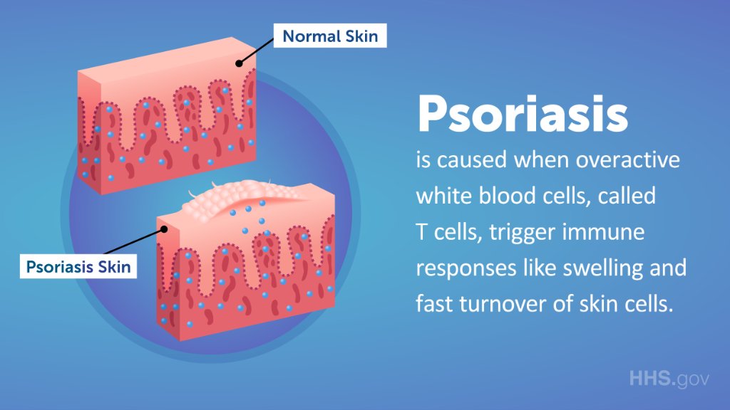 Típus kiütés psoriasis
