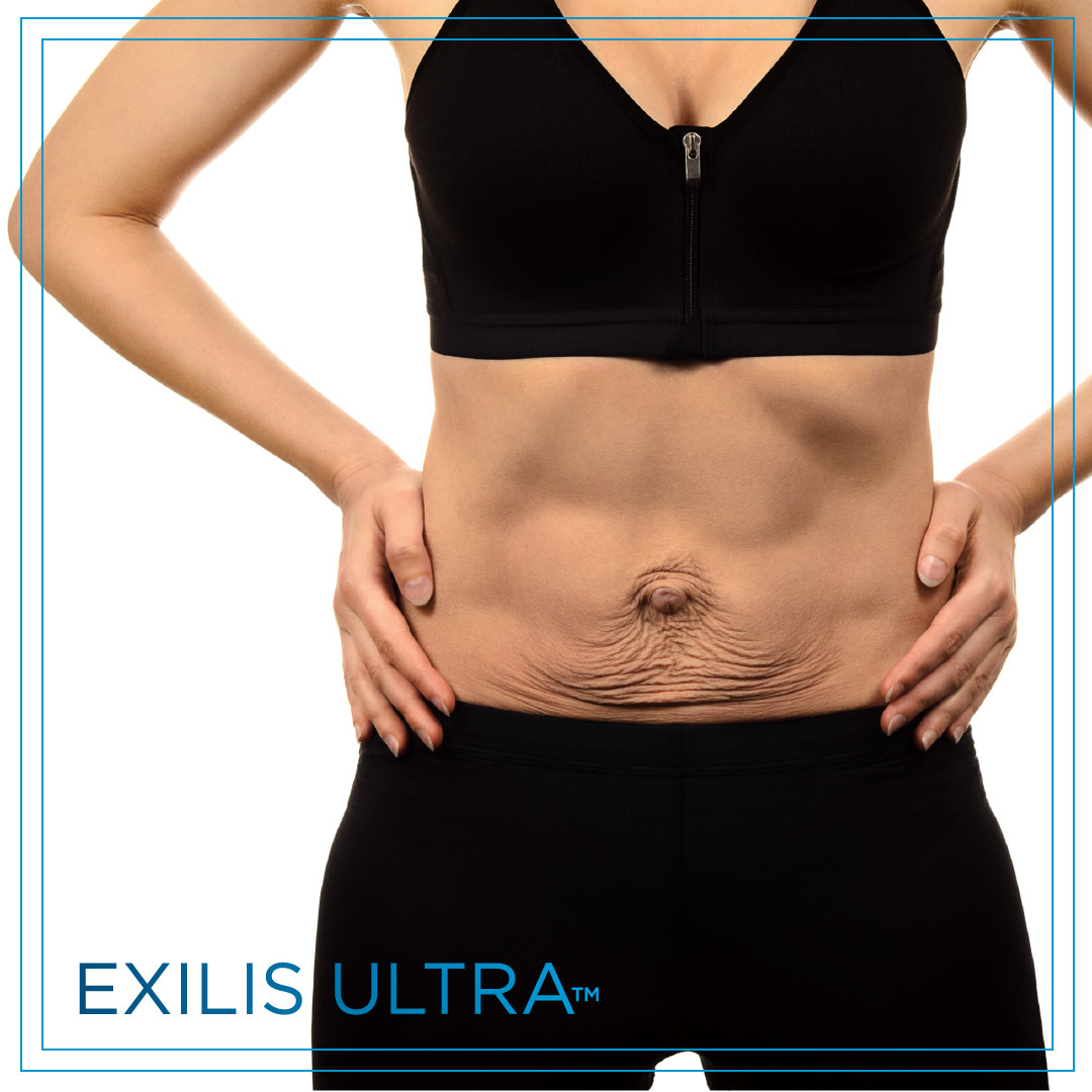 aron_monarch's tweet photo. Loose skin is often the final hurdle to jump in a weight-loss journey. 🏃🏻 Help your patients tighten their skin with the Exilis Ultra today!🏆
https://t.co/py0IJ8uWMA
#looseskin #bodyconfidence #postweightloss @BTLaesthetics https://t.co/5WThsDwhqF