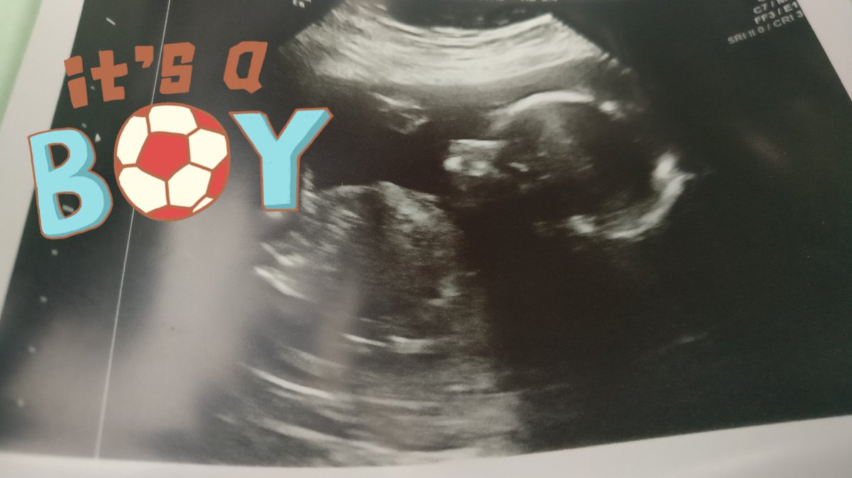 FrannypEmerald's tweet photo. We're officially at the halfway point... So me and Dave have decided to go ahead with announcements ๐. Sonographer says it looks like it's a boy ๐๐๐๐๐๐.
#DueJanuary #Itsaboy #excited #RainbowBaby https://t.co/KTUzAc4KSb