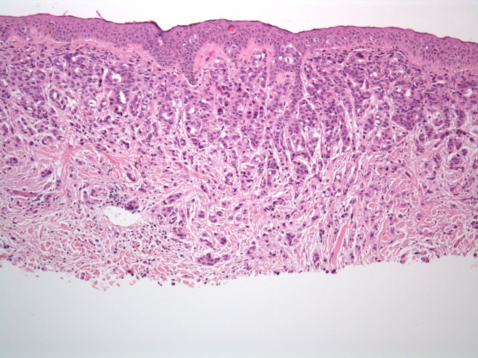 Direct Smear Atlas: A Monograph of Gram-stained Preparations