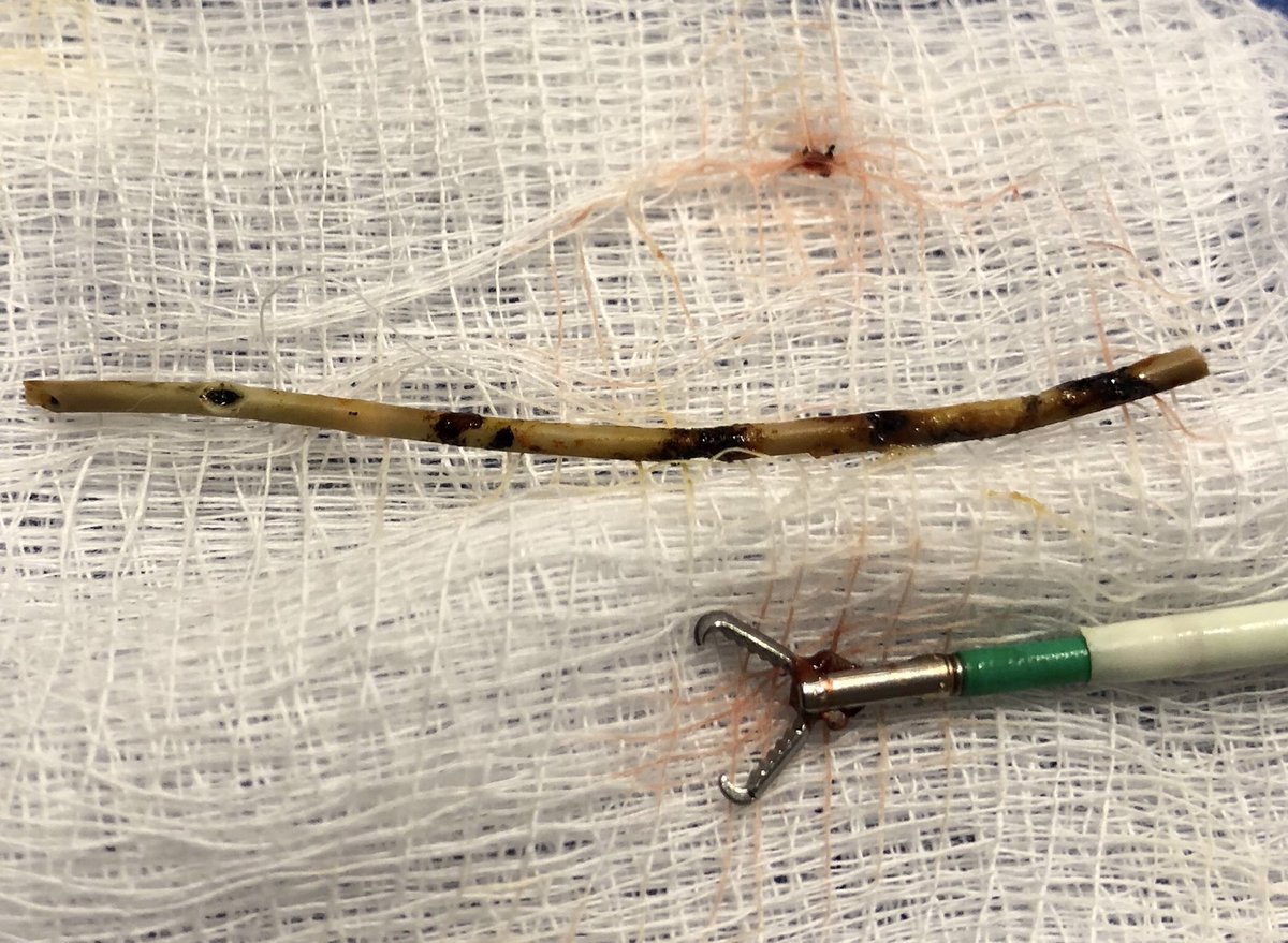jhussainMD's tweet photo. Liver transplant 24 years ago. MRCP/PTC look like a stone, but surprise surprise, retained drain from tx with stone forming on it. #biliaryendoscopy #IRendoscopy #lithovueFTW @medravi @CHICKVIR @IRadLab @IRadNAP @iRadRaj @mmkhayatmd @AlexCVIR @EJJohnsonMD https://t.co/e9ud3VfdlU