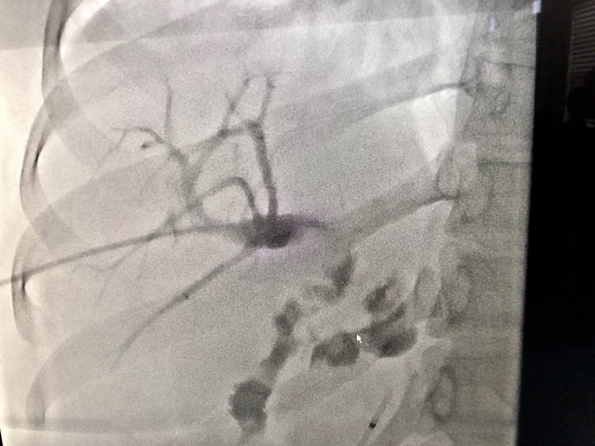 jhussainMD's tweet photo. Liver transplant 24 years ago. MRCP/PTC look like a stone, but surprise surprise, retained drain from tx with stone forming on it. #biliaryendoscopy #IRendoscopy #lithovueFTW @medravi @CHICKVIR @IRadLab @IRadNAP @iRadRaj @mmkhayatmd @AlexCVIR @EJJohnsonMD https://t.co/e9ud3VfdlU