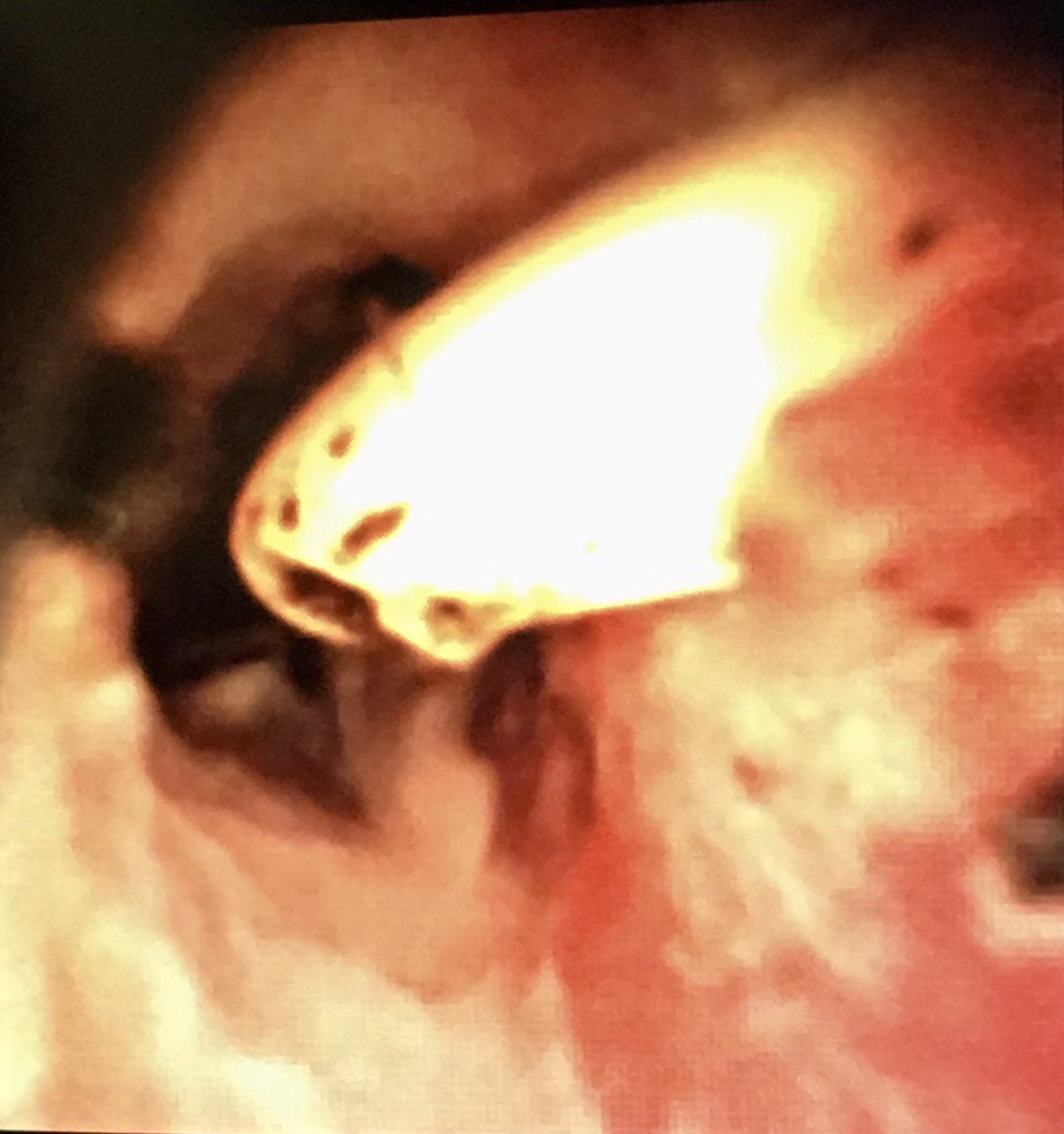 jhussainMD's tweet photo. Liver transplant 24 years ago. MRCP/PTC look like a stone, but surprise surprise, retained drain from tx with stone forming on it. #biliaryendoscopy #IRendoscopy #lithovueFTW @medravi @CHICKVIR @IRadLab @IRadNAP @iRadRaj @mmkhayatmd @AlexCVIR @EJJohnsonMD https://t.co/e9ud3VfdlU