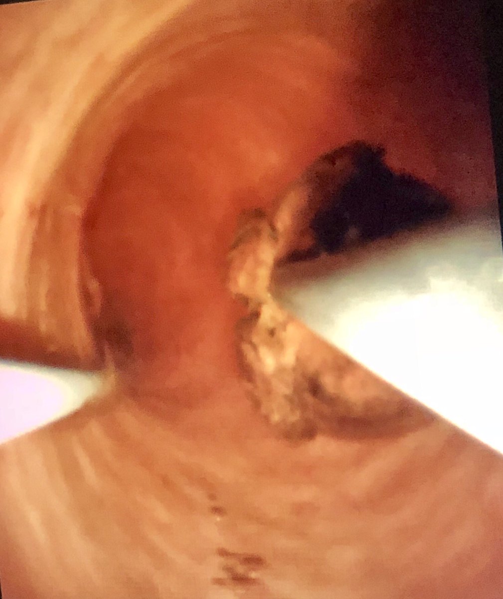 jhussainMD's tweet photo. RNY gastric bypass, CBD stones with obstruction. Single session PTC/biliary endoscopy to remove stones #IRendoscopy #biliaryendoscopy #LithoVue @CHICKVIR @medravi @IRadLab @AlexCVIR @IRadNAP @mmkhayatmd @iRadRaj @EJJohnsonMD https://t.co/BT3uc2cmUz