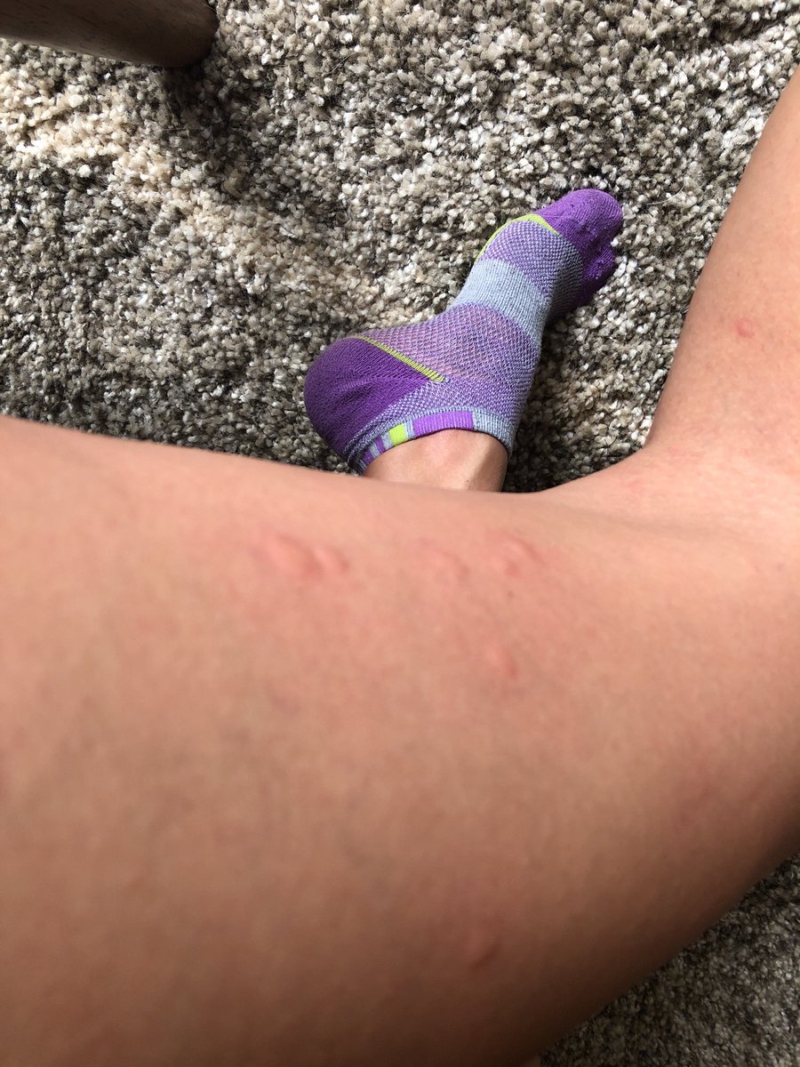 marielruizwx's tweet image. So much for yard work...I was outside MAYBE ten minutes. This is just one side of my leg 😩😭 #bugattack