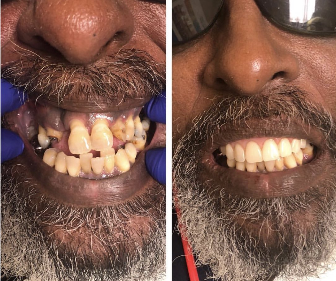 Just 1 of thousands of patients across the country receiving #donated #dentistry today on #smile4serveday 2018 from dedicated, caring and compassionate <a href="/smilegen/">Smile Generation</a> trusted dentists supported by <a href="/pacificdental/">Pacific Northwest Dental - Dentist Beaverton</a> - so proud to be part of this amazing organization <a href="/DentalAssoc5/">American Dental Association</a>