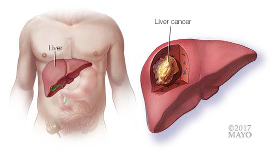 MayoClinic's tweet photo. The number of people dying of #LiverCancer is on the rise — up 43 percent since 2000, according to the Centers for Disease Control and Prevention. Could you be at risk? Here's what you need to know. https://t.co/bxCgPkxbOZ https://t.co/vy9AocJzVi