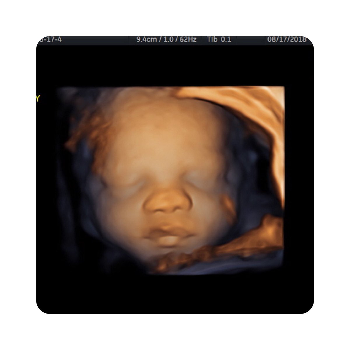 baby_dimensions's tweet photo. Beautiful #3dimage of a #baby at #28 weeks. Timing, and fabulous #amnioticfluid or key ingredients to getting imaging this #clear. #babydimensions.com To see everything that we do. https://t.co/gnYUwII9VB