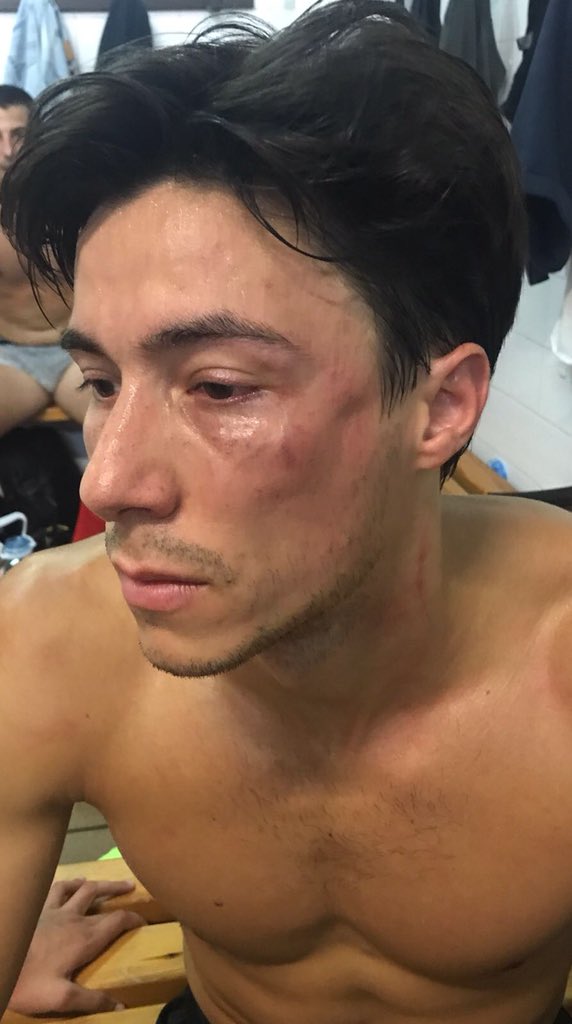 UERubi's tweet photo. Així ha quedat la cara de Jan Llado després de l'agressió d'un jugador del @cfgavaoficial... No a la violència en el futbol, ens veuen xiquets i hem de donar exemple als nanos. Ànim Jan! https://t.co/ndpUiB0omk