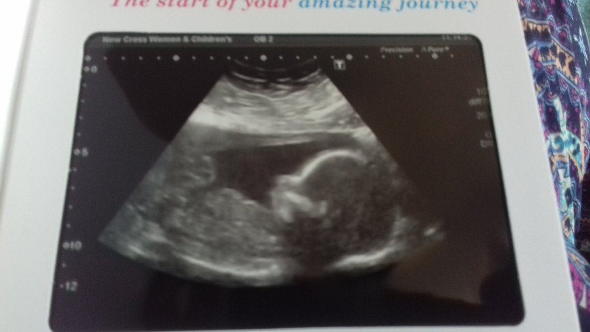 Babyawesome2's tweet photo. Tomorrow it will be 16 weeks until I finally make my debut in the world!!!  ❤❤❤ mummy and daddy are super excited 🍼🍼 #Hardcorebaby #WalkWithElias https://t.co/pOf56IpsKu