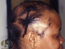 - And pulled too tightly, and worn too often? The weight/tightness of braids can cause traction alopecia, where constant tension on the hair shaft damages the root and causes the hair to fall out.This can be reversible... and it can be permanent.