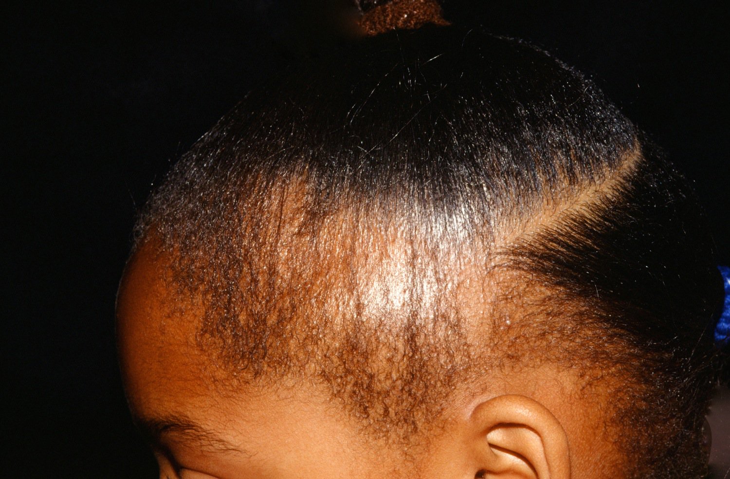 Инфильтративно-нагноительная трихофития волосистой части головы