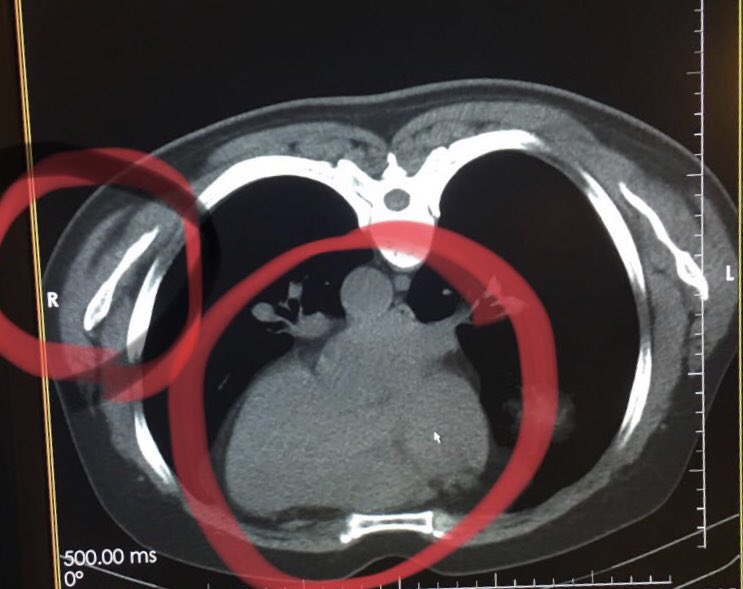 #simplesteps to improve #radiology quality: check with technologists when you see a dextrocardia. Most often a positioning error.