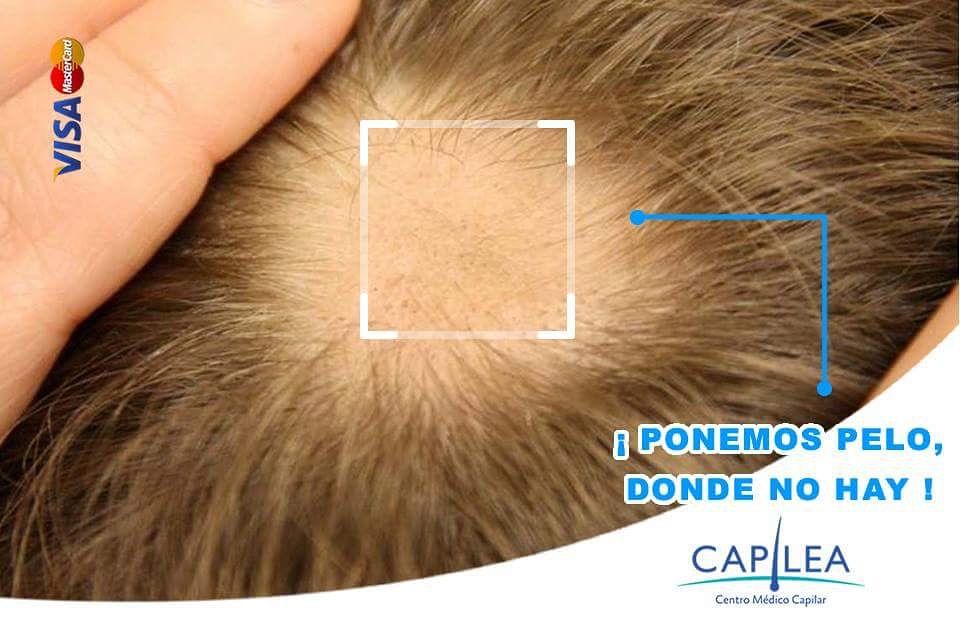 CapileaMx's tweet photo. ¡ No pierdas tu cabello, Ponemos pelo donde no hay !

Microinjerto de #Barba, #Cabello y #Ceja https://t.co/uSzKJlB0Qf