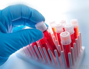 karlyve's tweet photo. Sickle Cell Trait Skews Common Diabetes Test - https://t.co/CBgRIdypzq https://t.co/Hw5ijhLMdZ