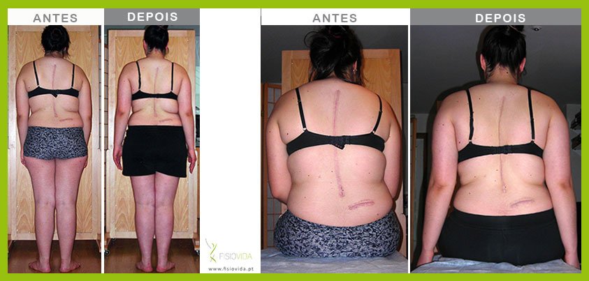 FISIOVIDAPT's tweet photo. Escoliose só com cirurgia? Veja o caso clínico nº 3
https://t.co/1usm44WdhG
#ReeducaçãoPosturalGlobal  #RPG #MáPostura #DorCostas #Escoliose #TratamentoEscoliose #CorrigirPostura  #FISIOVIDA #fisiovidapt https://t.co/6uQrPWCsBP