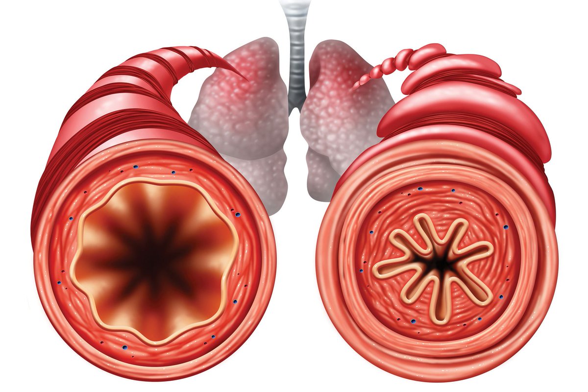 spirosure's tweet photo. Check out the latest evidence-based recommendations in #asthma treatment @ManagedCareMag. Leading experts, including @atscommunity, agree: monitoring exhaled NO measurements is a cost-effective, accessible strategy for asthma management. https://t.co/A1UzyUXeCf https://t.co/O0prXB37yW