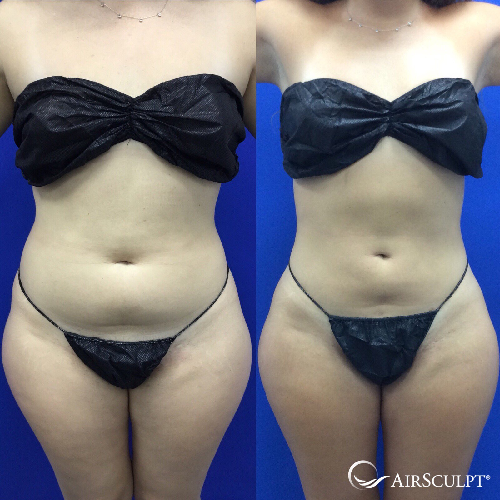 AirSculpt on X: 👀 Can you believe it?! This patient went down