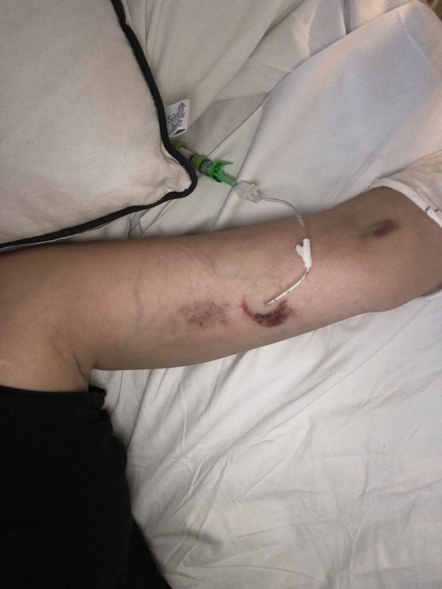 KToogie's tweet photo. It looks like the bruise around my midline is a phase of the moon #cysticfibrosis #dressingchange https://t.co/1ta3mGVuk1
