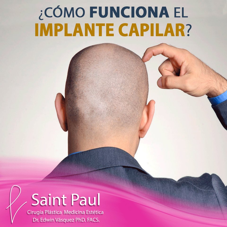 CapilarCenter's tweet image. 👉Recupera tu pelo para siempre en 4 pasos: Incisiones alrededor de los folículos.Extracción de las unidades foliculares. Separación y control de calidad de los injertos, Implante de los folículos. ⠀
👉#CITA aquí goo.gl/HbnVvr y recibe S/.30 de descuento en la Consulta