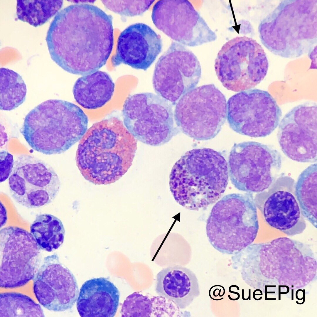 SueEPig's tweet photo. Immature cells with folded monocytoid nuclei mixed with abnormal eosinophils (arrow), containing large basophilic granules and more normal eosinophilic granules #harlequincell #AMML #M4EoS #Inv16 #CBFBMYH11fusion #hhpath #hemepath https://t.co/b4T9g35ahI