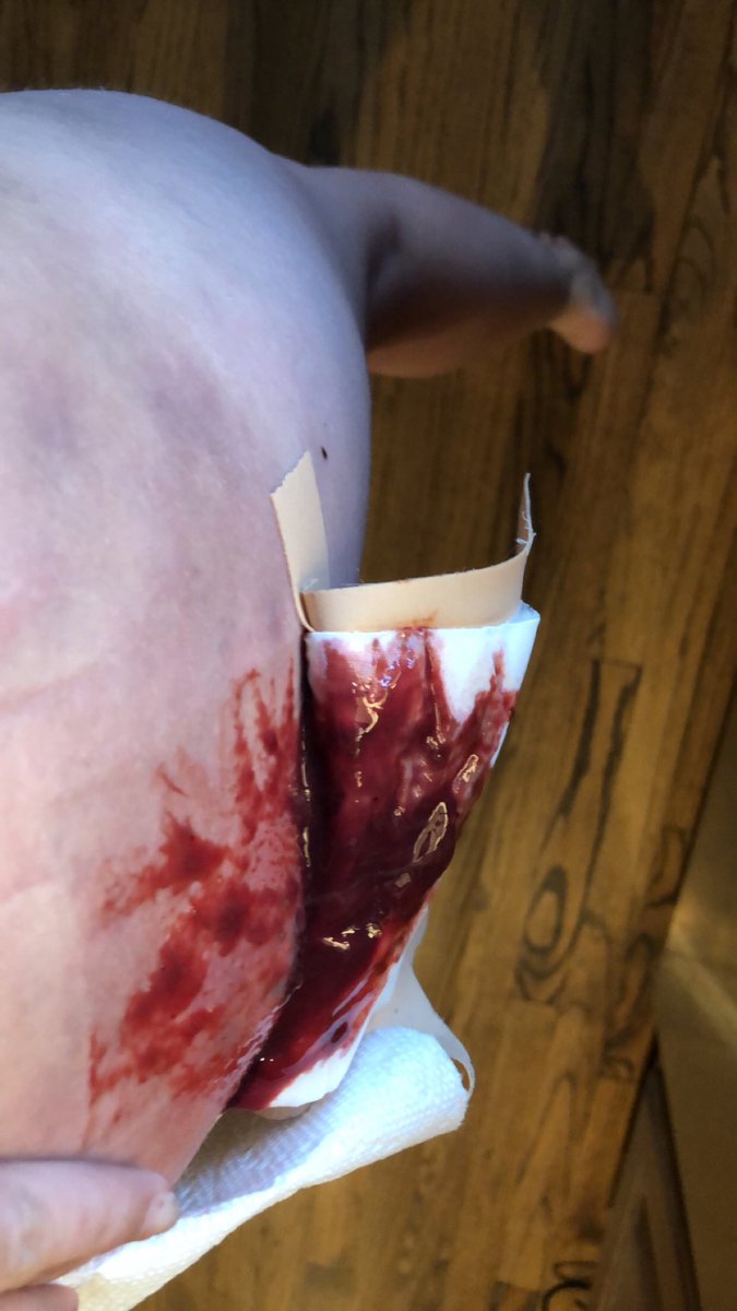PayPayLaPeww's tweet photo. Well that can’t be good. #RIPMyAss 😭😭😭 I hate my life rn. Why am I always injuring myself like this https://t.co/BidmTnvvGZ