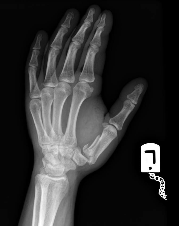 RadiologySigns's tweet photo. Q: What is this fracture called? ANSWER: https://t.co/FRRN1Czbuj #FOAMrad FOAMed https://t.co/qv6qCoKowB