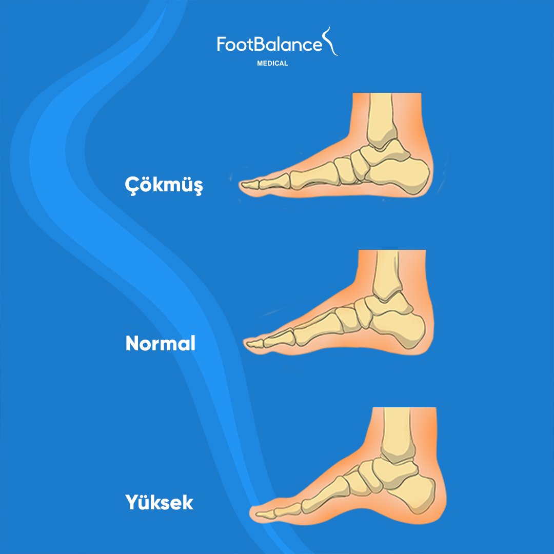 FootBalance Medical ortopedik tabanlıkları; #tabançökmesi gibi ayakta sıkça görülen medikal problemler için, uzman fizyoterapistlerimiz ile kişiye özel destek ve yastıklamalarla sağlıklı ayak işlevleri için eşsiz çözüm sunar.