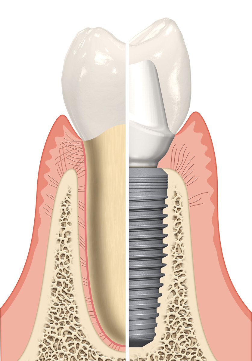 BrightSStudio1's tweet photo. A missing tooth can lead to:
📌Drifting/shifting neighbouring teeth;
📌Increased biting stress on other teeth;
📌Bone loss;
📌Gap between teeth widens;
📌Losing natural smile. 
Book a consultation to find out your options.
#WednesdayWisdom #Implant #Oralhealth #OSSTEM #Dentistry https://t.co/h998VsnCGF