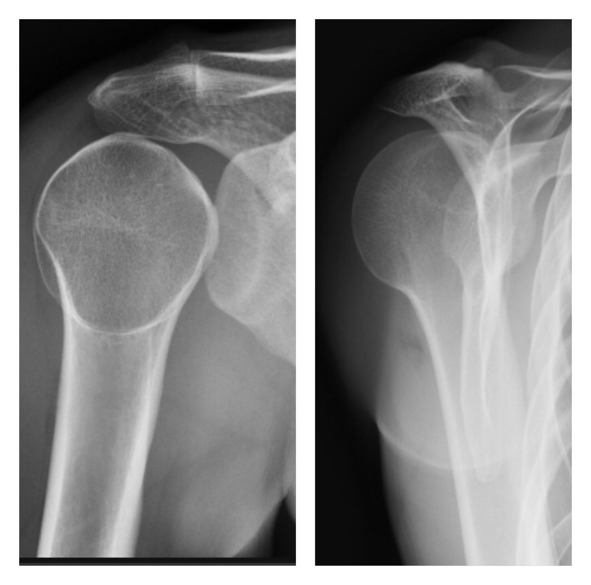 luxacion anterior de hombro radiografia