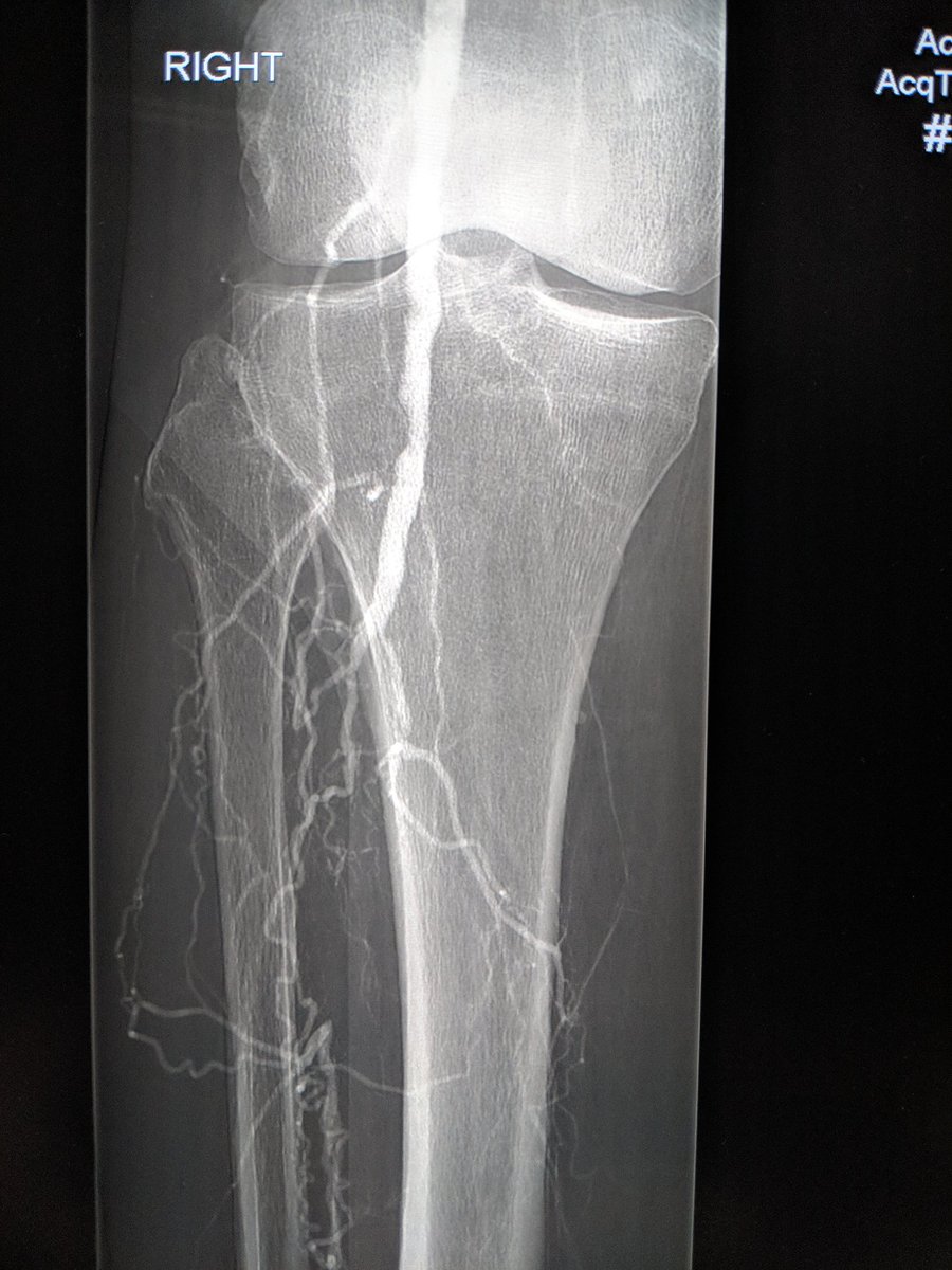 DylanKurda's tweet image. Optimising flow results in wound healing and #stopthechop #iRad #MyLegMyLife
